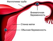 Вероятность внематочной беременности. Внематочная беременность. Внематочная беременность в печени. Внематочная Трубная беременность.